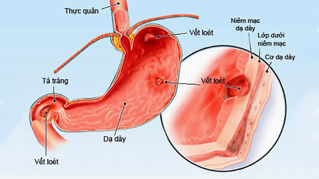 Phù nề dạ dày