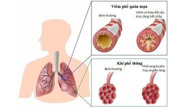 Tắc nghãn phổi mãn tính
